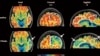 Alzheimer's Drugs Might Get Into the Brain Faster With New Ultrasound Tool