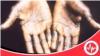 Mpox is no hoax and COVID-19 vaccine has nothing to do with it
