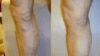 FILE: Unyawo olulesifo sevaricose veins lokwenzakala ungelatshwa