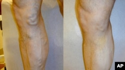 FILE: Unyawo olulesifo sevaricose veins lokwenzakala ungelatshwa