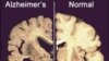 This undated image provided by Merck & Co., shows a cross section of a normal brain (R) and one of a brain damaged by advanced Alzheimer's disease, December 3, 2012.